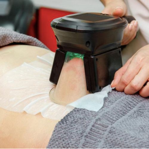 CoolSculpting
