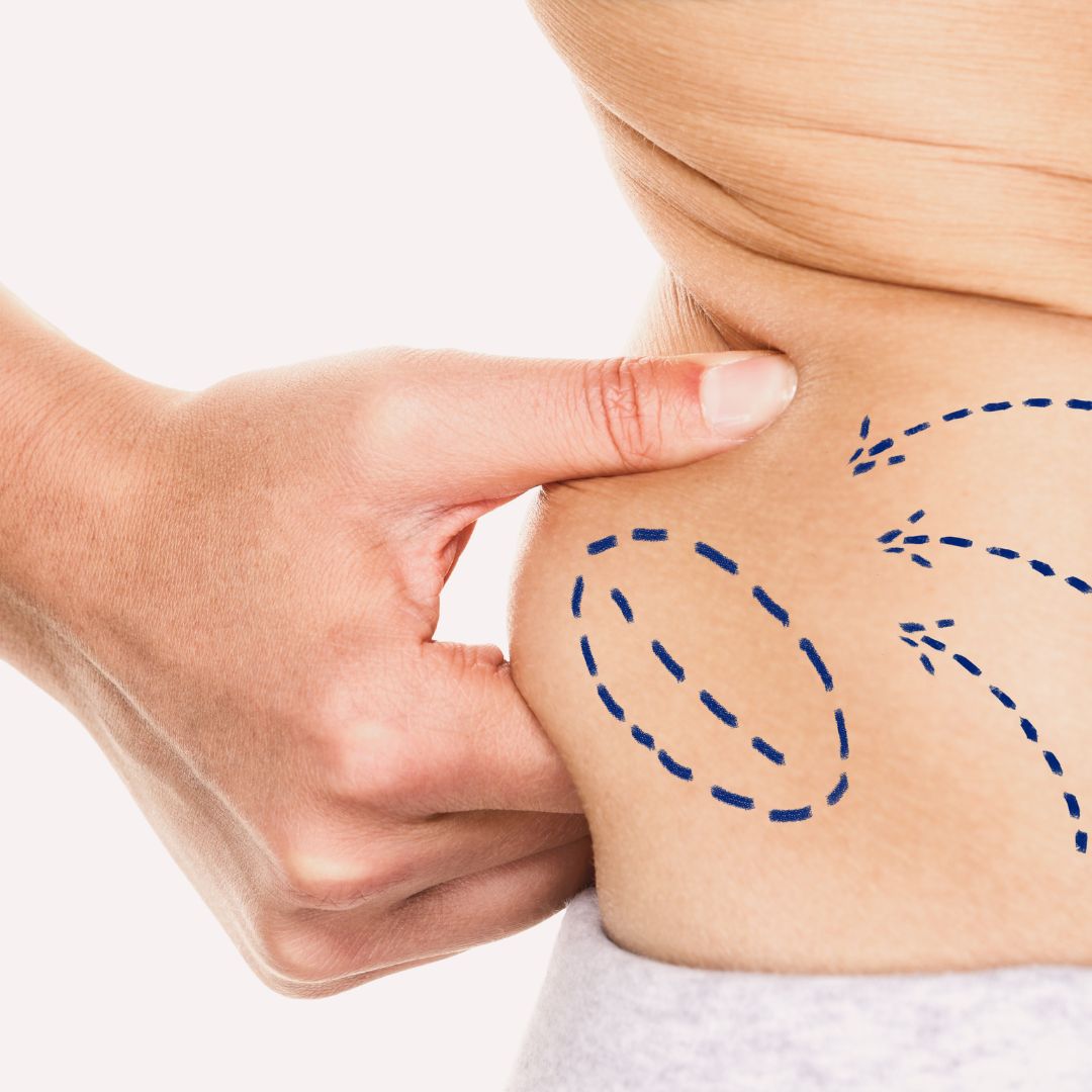 Liposuction
